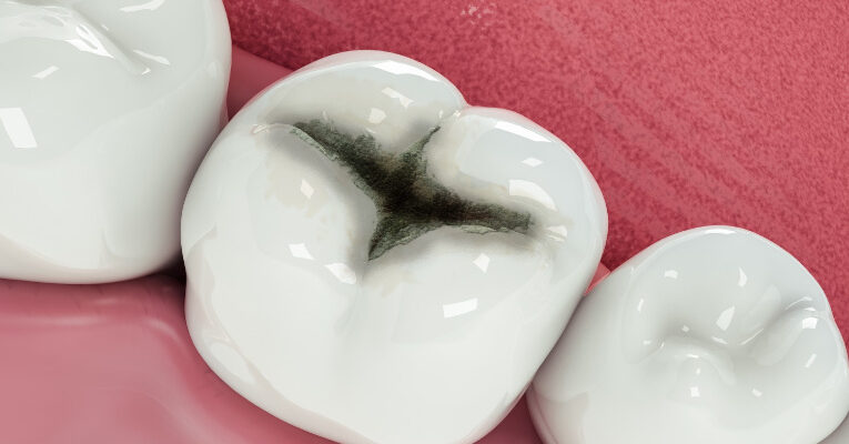 widok-z-próchnicy-zębów