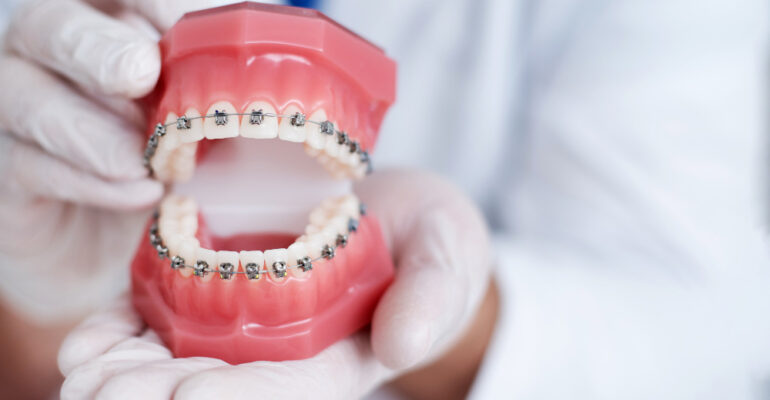 aparat ortodontyczny