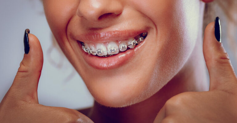 ligatura ortodontyczna