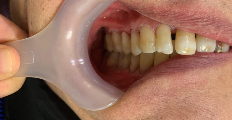 przebarwienia na zębach