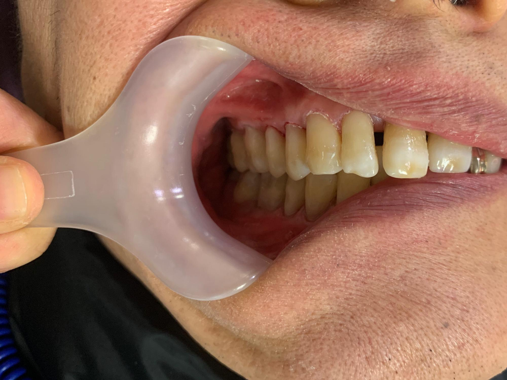 przebarwienia na zębach