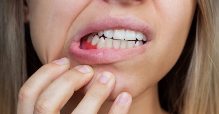 stany zapalne dziąseł