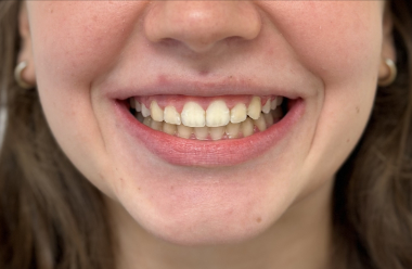 po leczeniu ortodontycznym aparatem stałym