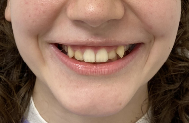 przed leczeniem ortodontycznym aparatem stalym