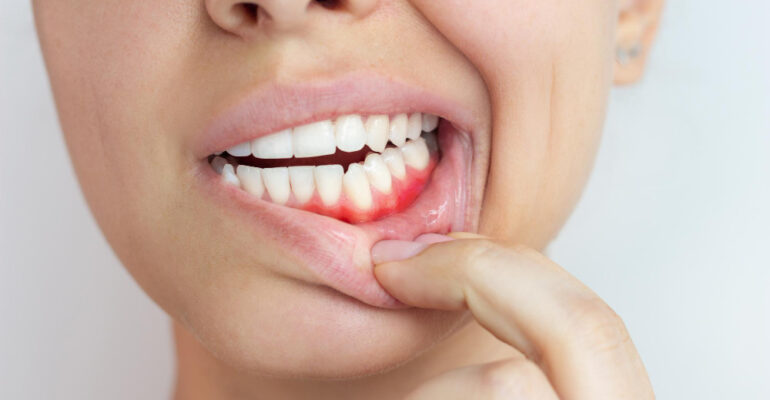 spuchnięte dziąsło